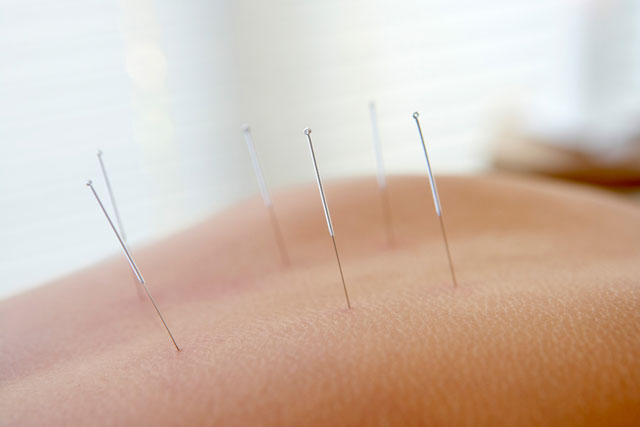 Acupuncture Relieves Symptoms of Post-Traumatic Stress Disorder and Ushers in Healing
