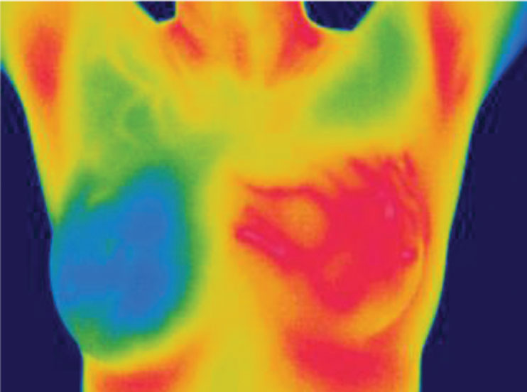 Thermography for Breast Cancer Screening