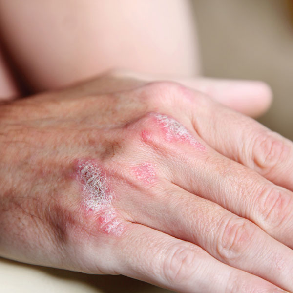 Psoriasis: The Problem Is Not Just Skin Deep