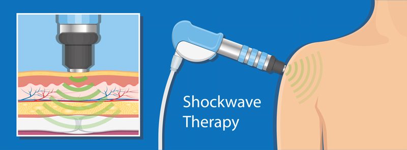 Shockwave Therapy