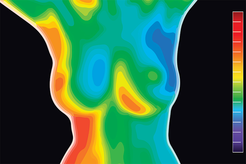 Thermography Unveiling Breast Health Insights